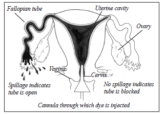 Illustration for article titled Hysterosalpingogram